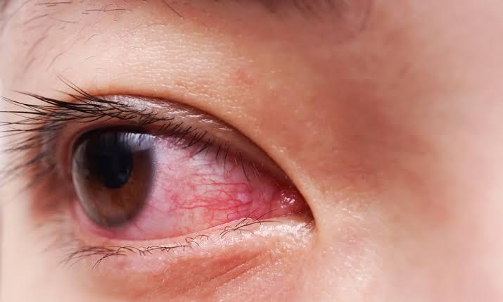 Tanger : 13 cas d’inflammation oculaire après une même séance