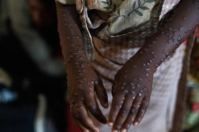 Afrique du Sud : le mpox progresse rapidement, 18 cas confirmés