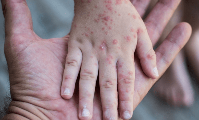 Rougeole : 8 décès, faut-il craindre une épidémie au Maroc ?