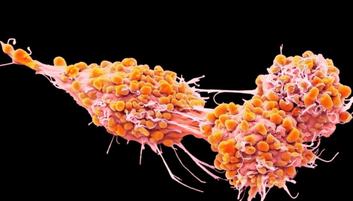 Cancer de l’ovaire : le rôle des plaquettes sanguines en question