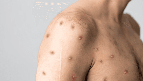 Premier cas confirmé de variole du singe au Maroc 