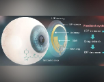 Science: une lentille intelligente pour traiter le glaucome
